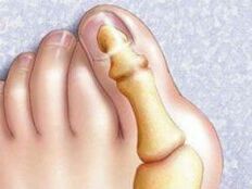 Hallux valgus deformatsioon