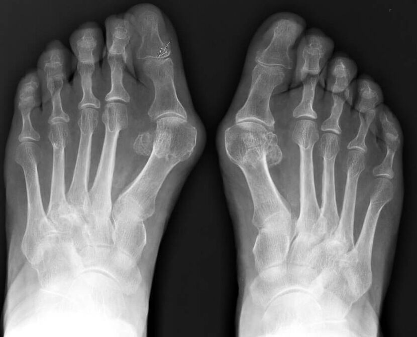 Röntgenipilt hallux valgus