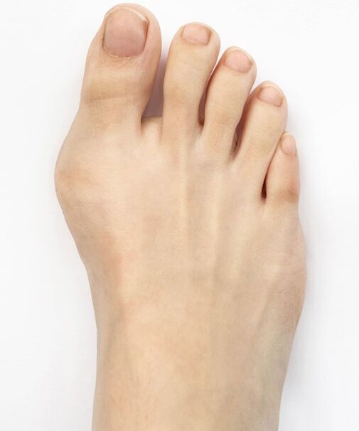 hallux valgus enne Hondro Sol Valgus pihusti kasutamist